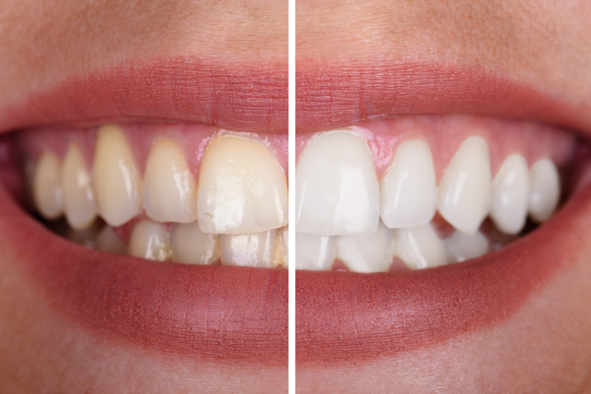 Can Teeth Whitening Damage Gums