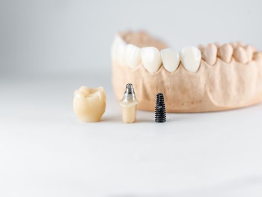 How Long Will a Dental Implant Hurt