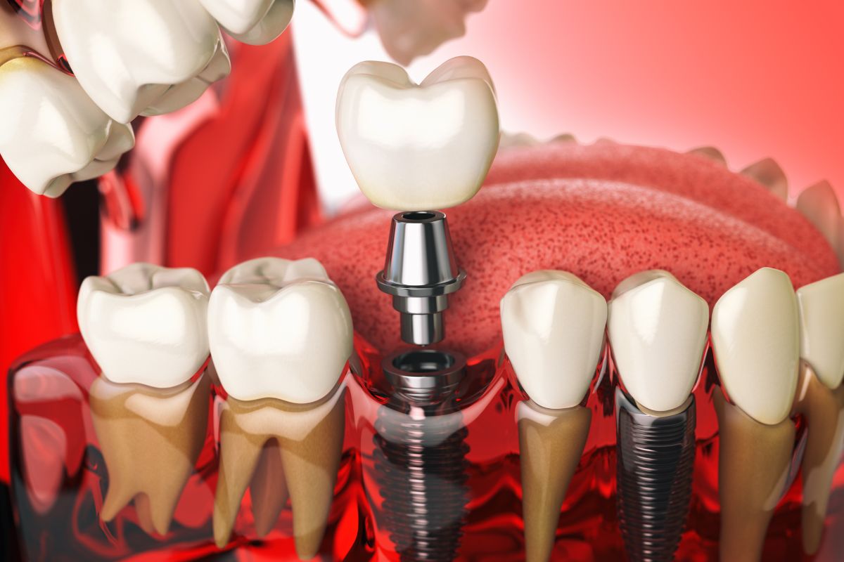 Top Questions to Ask Your Implant Dentist