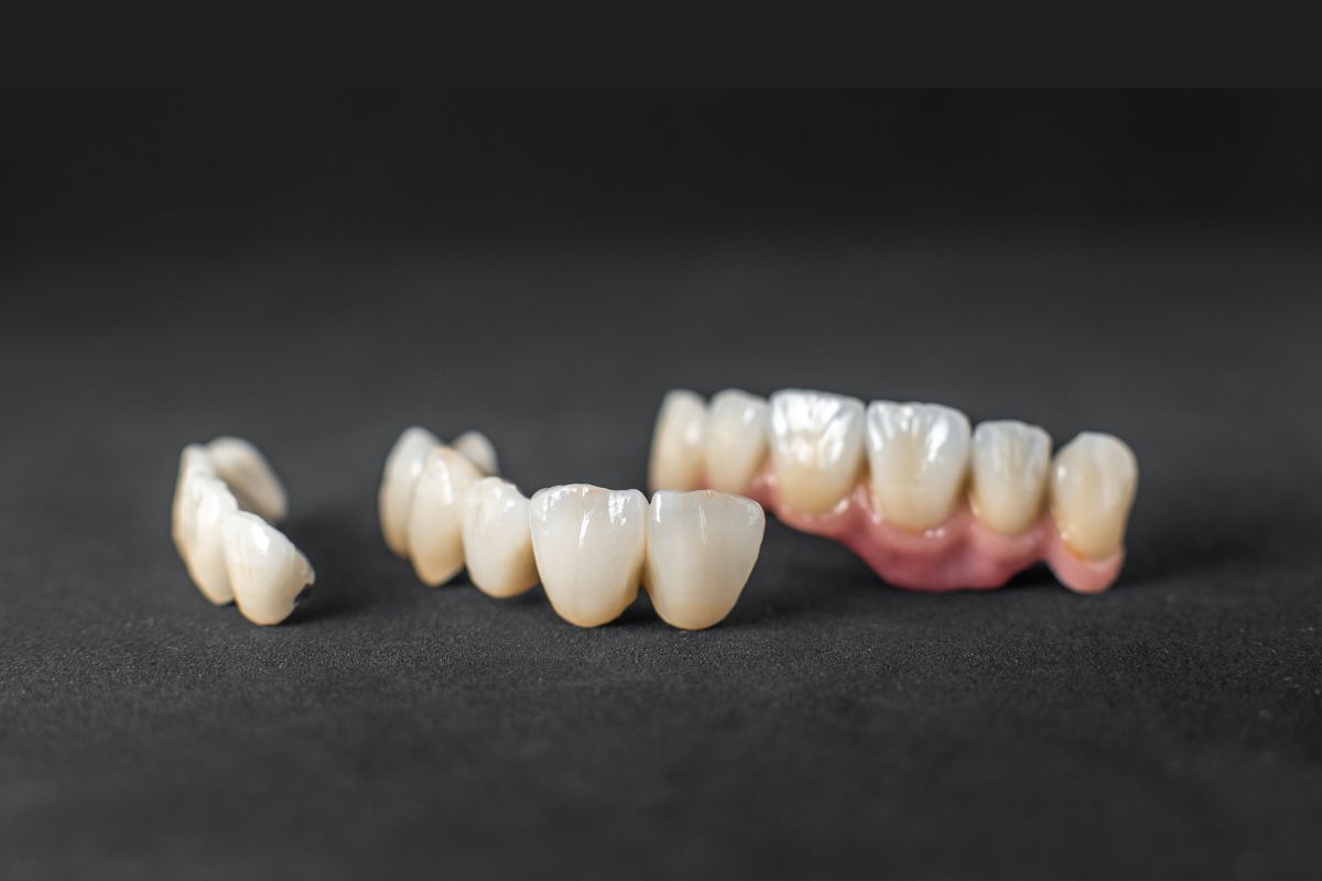 Zirconia Crowns or Dental Fillings