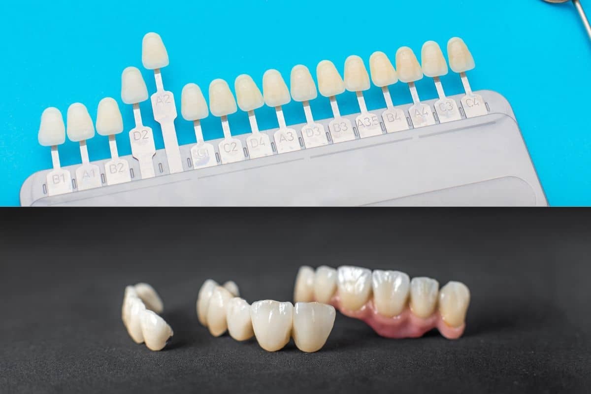 Dental veneer and crown shade guide showing tooth color samples and restoration options for cosmetic dentistry in Stuart.